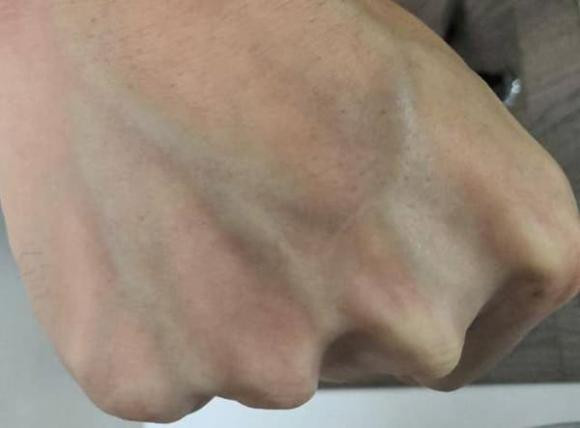 Gân xanh nổi rõ khi nào là bình thường, khi nào là dấu hiệu bệnh?