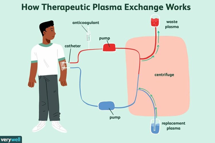 plasma-exchange-ms-treatment-2440905final-10c679e9354348a5b5a2a74555ce33b4-1738653437961704261...jpg plasma-exchange-ms-treatment-2440905final-10c679e9354348a5b5a2a74555ce33b4-1738653437961704261...jpg