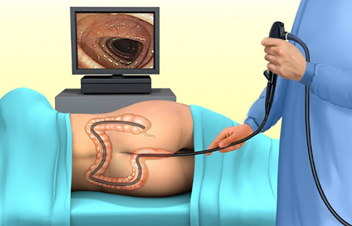 Nên chọn nội soi tiêu hóa thường hay gây mê? Ưu và nhược điểm của từng phương pháp nội soi là gì?