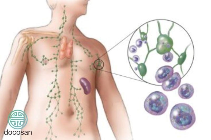 Bệnh u lympho là gì? Triệu chứng khó nhận biết và hướng điều trị mới nhất